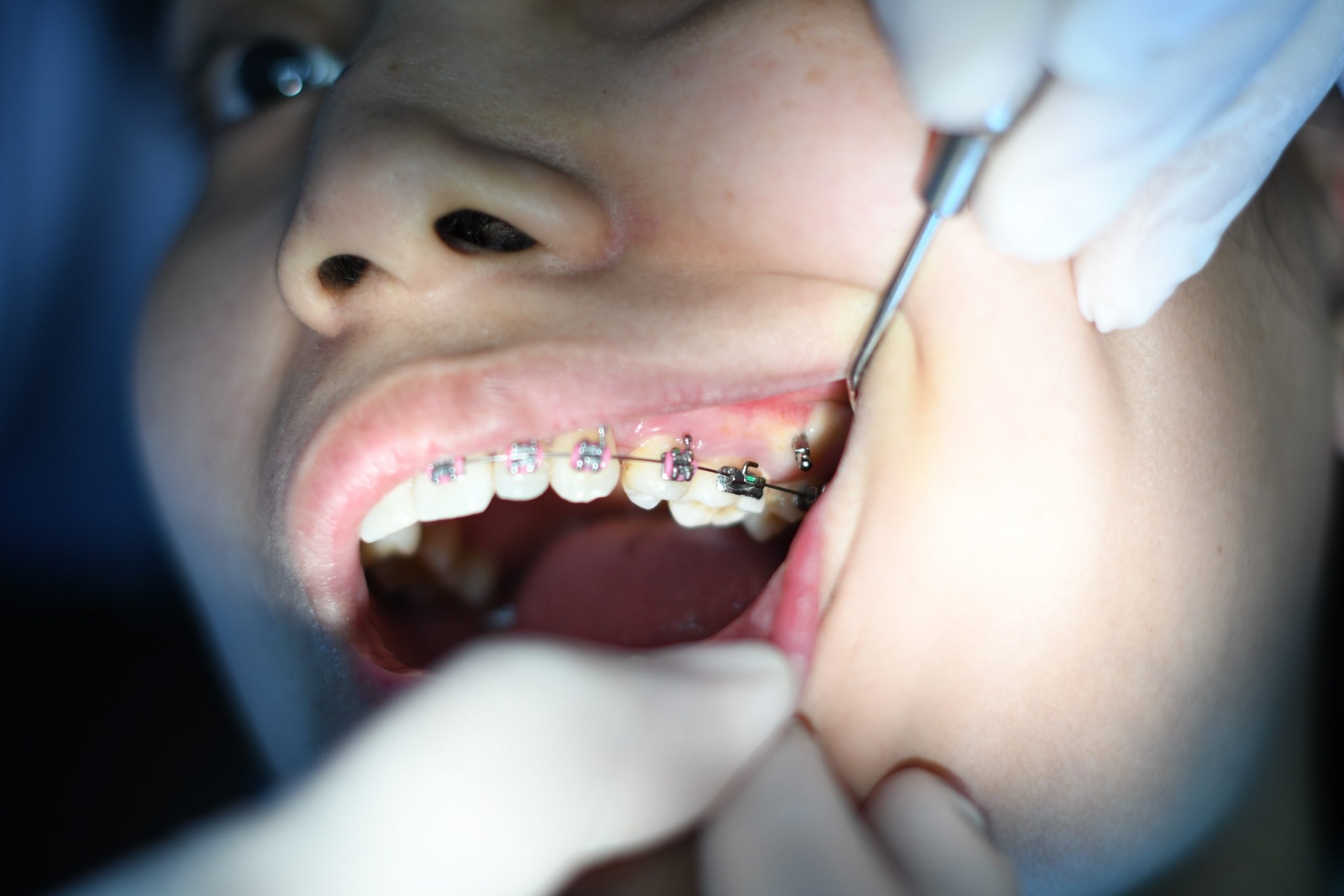 Aligners vs Braces: Pros, Cons and One Big Myth 1 алайнери или брекети