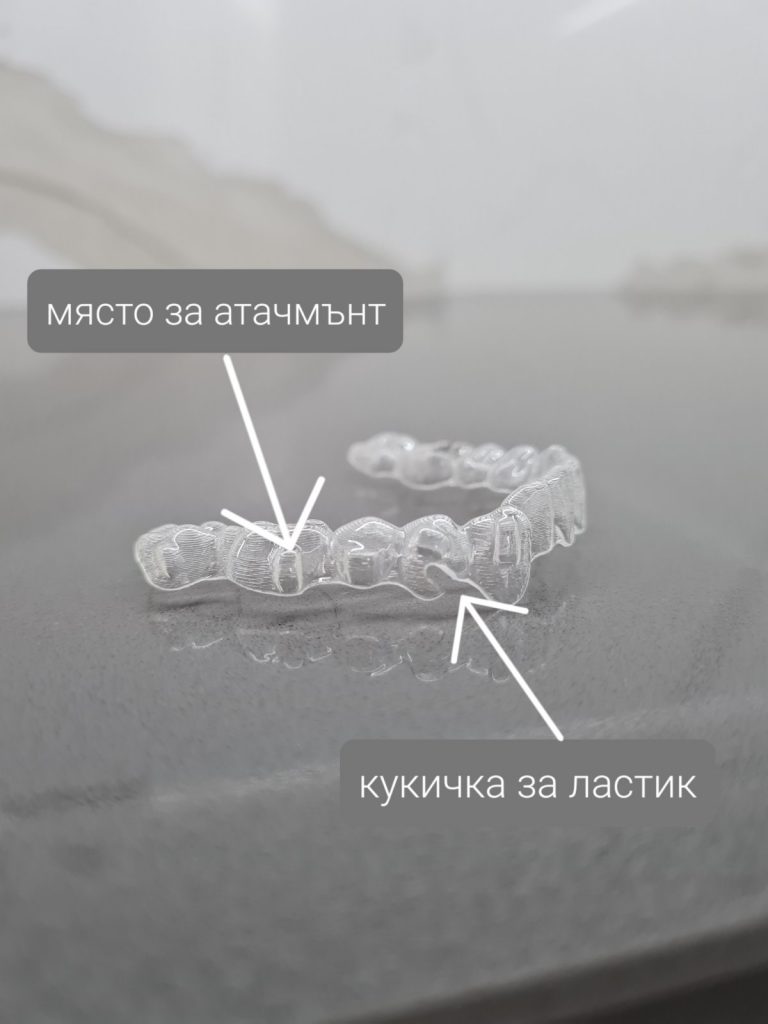 Aligner Elastics and Buttons: What They Do, How to Put Them On and How Often to Change Them 3 Aligner elastics and buttons – an elastic between a button and a cut in the aligner