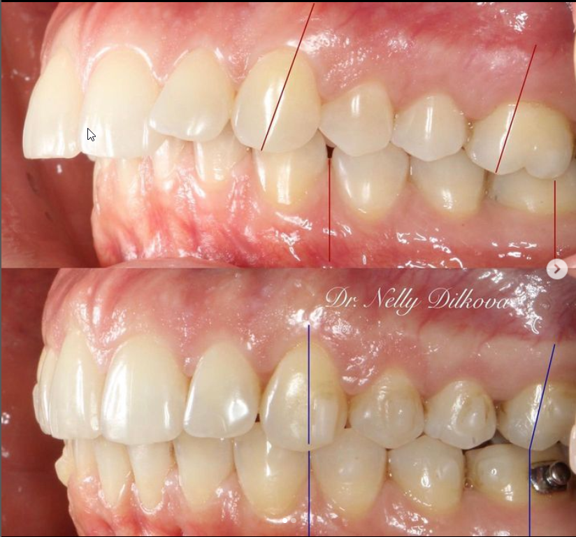 Conversations with Orthodontists: Dr Neli Dilkova on Clear Aligners 2 Dr Neli Dilkova – a case treated with clear aligners