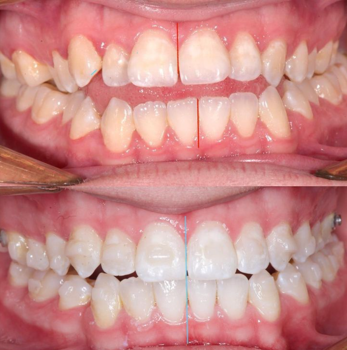 Open bite and crossbite treated with Invisalign clear aligners – Dr Teodora Todorova