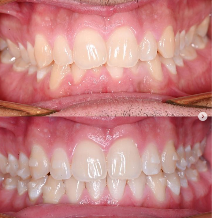 Deep bite treated with Invisalign clear aligners – Dr Teodora Todorova
