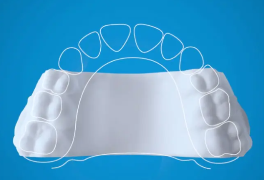 Експандер за зъби без метал: Invisalign Palatal Expander за деца 1 Експандер за зъби без метал: Invisalign Palatal Expander за деца