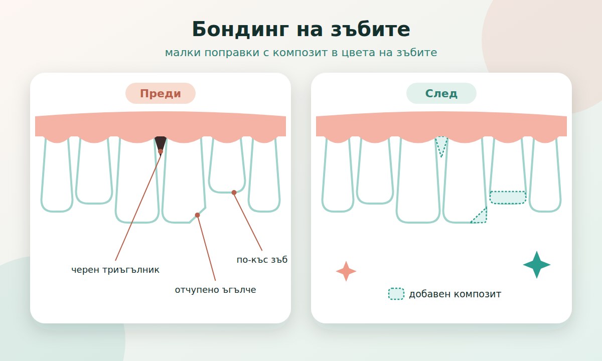 Бондинг на зъбите: какво е и кога след алайнери 2 Бондинг на зъбите – преди и след: отчупено ъгълче, черен триъгълник и по-къс зъб, поправени с композит