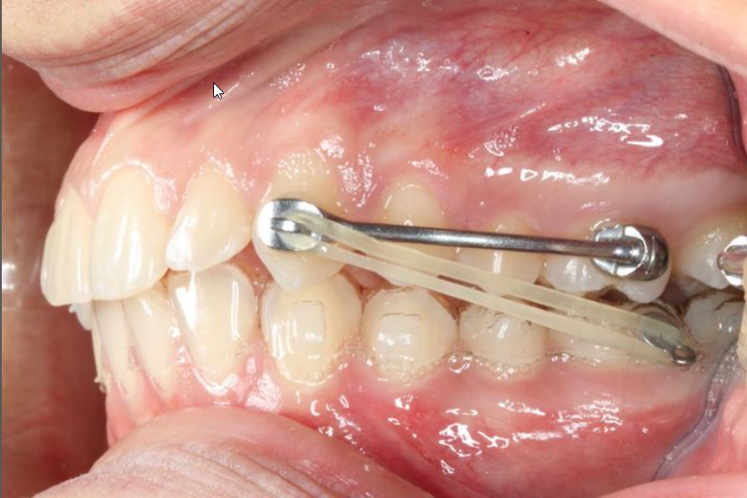 Carriere Motion Appliance: How It Works and Does It Help? 2 Carriere Motion on the upper teeth and an aligner on the lower teeth for a Class II bite