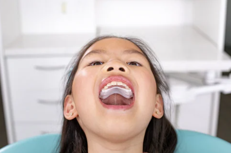 Експандер за зъби без метал: Invisalign Palatal Expander за деца 3 Експандер за зъби Invisalign – апаратчета за разширяване на горната челюст при деца