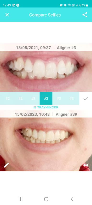 TrayMinder – teeth photos to compare progress