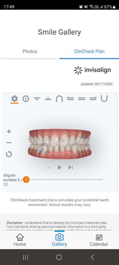 ClinCheck treatment plan in the My Invisalign app