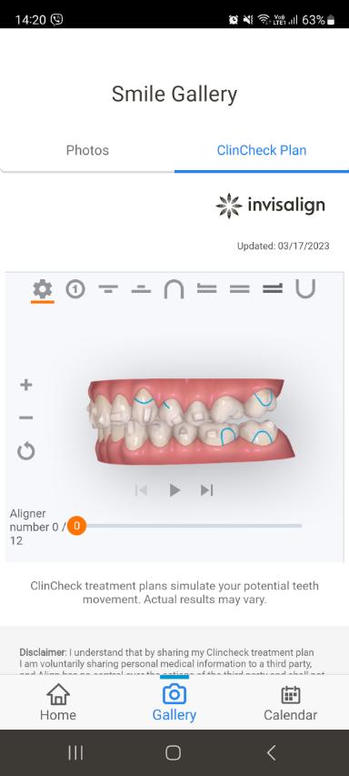 Treatment plan stages in the My Invisalign app