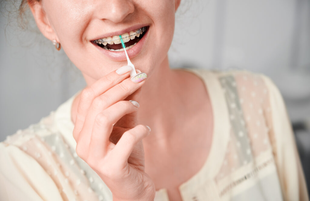 Aligners vs Braces: Pros, Cons and One Big Myth 2 Aligners vs braces – cleaning teeth with braces using an interdental brush
